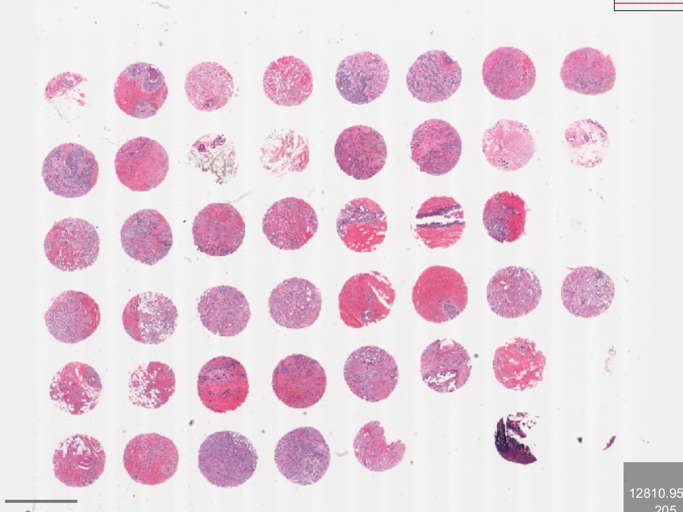 A tissue microarray slide: a grid of round, pink-and-purple stained tissue cores